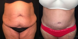 Before and after Tummy Tuck case 35173 - Angle 1