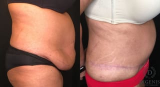 Before and after Tummy Tuck case 35173 - Angle 3