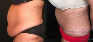 Before and after Tummy Tuck case 35173 - Angle 5