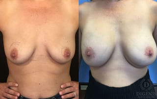 Before and after Breast Lift with or without Implants case 35174 - Angle 1
