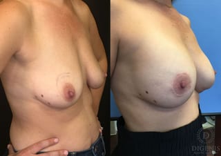 Before and after Breast Lift with or without Implants case 35174 - Angle 2