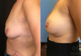 Before and after Breast Lift with or without Implants case 35174 - Angle 5