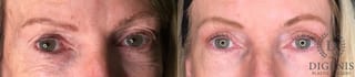 Before and after Eye Lid Surgery case 35175 - Angle 1