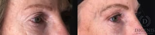 Before and after Eye Lid Surgery case 35175 - Angle 2