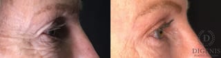 Before and after Eye Lid Surgery case 35175 - Angle 3