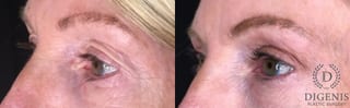 Before and after Eye Lid Surgery case 35175 - Angle 4
