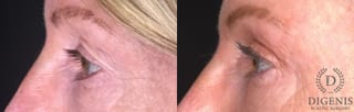 Before and after Eye Lid Surgery case 35175 - Angle 5