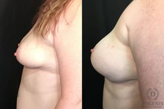 Before and after Breast Lift with or without Implants case 35178 - Angle 5
