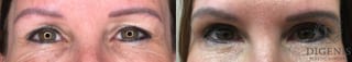 Before and after Eye Lid Surgery case 35179 - Angle 1
