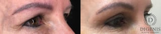 Before and after Eye Lid Surgery case 35179 - Angle 2