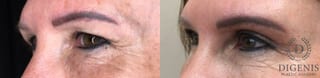 Before and after Eye Lid Surgery case 35179 - Angle 4