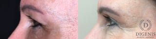 Before and after Eye Lid Surgery case 35179 - Angle 5