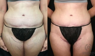 Before and after Tummy Tuck case 35180 - Angle 1