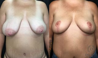 Before and after Breast Lift with or without Implants case 35181 - Angle 1