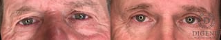 Before and after Eye Lid Surgery case 35183 - Angle 1