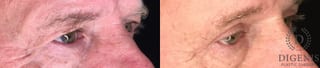 Before and after Eye Lid Surgery case 35183 - Angle 2