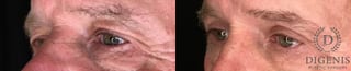 Before and after Eye Lid Surgery case 35183 - Angle 4