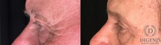 Before and after Eye Lid Surgery case 35183 - Angle 5