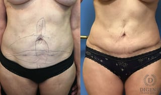 Before and after Tummy Tuck case 35184 - Angle 1