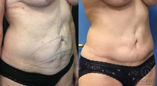 Before and after Tummy Tuck case 35184 - Angle 2