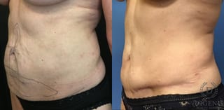 Before and after Tummy Tuck case 35184 - Angle 4