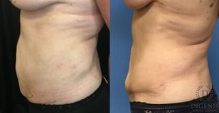 Before and after Tummy Tuck case 35184 - Angle 5