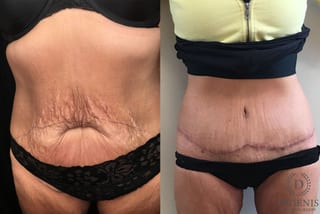 Before and after Tummy Tuck case 35185 - Angle 1