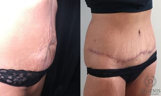 Before and after Tummy Tuck case 35185 - Angle 2