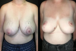 Before and after Breast Reduction case 35186 - Angle 1
