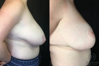 Before and after Breast Reduction case 35186 - Angle 3