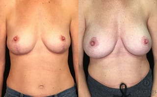 Before and after Breast Augmentation case 35187 - Angle 1
