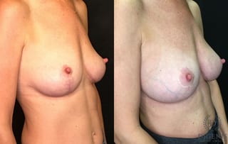Before and after Breast Augmentation case 35187 - Angle 2