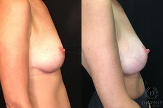 Before and after Breast Augmentation case 35187 - Angle 3
