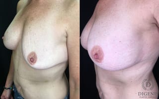 Before and after Breast Implant Exchange or Removal case 35188 - Angle 4