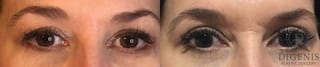 Before and after Eye Lid Surgery case 35189 - Angle 1