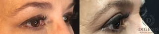 Before and after Eye Lid Surgery case 35189 - Angle 2