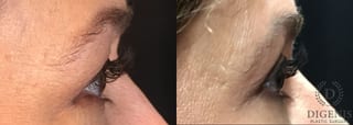 Before and after Eye Lid Surgery case 35189 - Angle 3