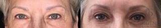 Before and after Eye Lid Surgery case 35190 - Angle 1