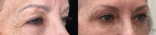 Before and after Eye Lid Surgery case 35190 - Angle 2