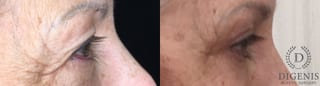 Before and after Eye Lid Surgery case 35190 - Angle 3