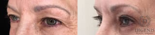 Before and after Eye Lid Surgery case 35190 - Angle 4