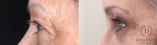 Before and after Eye Lid Surgery case 35190 - Angle 5