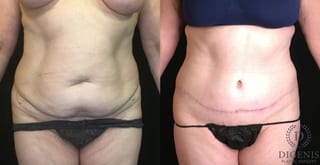 Before and after Tummy Tuck case 35191 - Angle 1