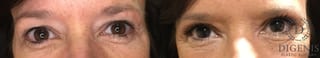 Before and after Eye Lid Surgery case 35192 - Angle 1