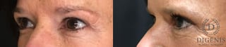Before and after Eye Lid Surgery case 35192 - Angle 4