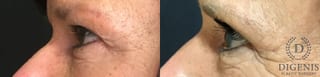 Before and after Eye Lid Surgery case 35192 - Angle 5