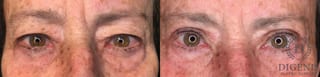 Before and after Eye Lid Surgery case 35193 - Angle 1