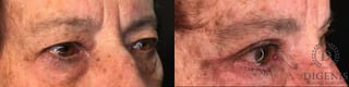 Before and after Eye Lid Surgery case 35193 - Angle 2