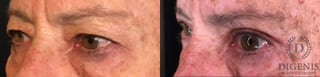 Before and after Eye Lid Surgery case 35193 - Angle 4