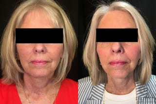 Before and after Temple Lift case 35194 - Angle 1